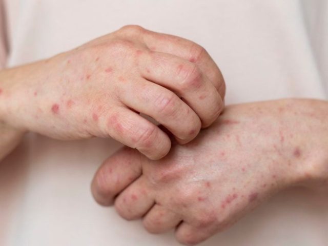 No hay casos sospechosos de sarampión en escuelas de Querétaro